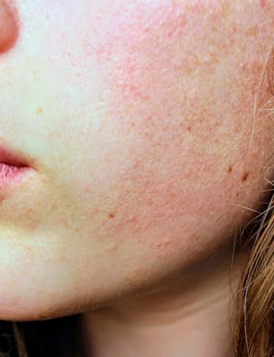 Jodmangel bei Vegetariern: Ursachen, Symptome und pflanzliche Lösungen