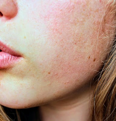 Jodmangel bei Vegetariern: Ursachen, Symptome und pflanzliche Lösungen