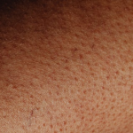 Vitamin-B5-Mangel bei Vegetariern: Ursachen, Symptome und pflanzliche Lösungen