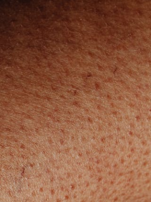 Vitamin-B6-Mangel bei Vegetariern: Ursachen, Symptome und pflanzliche Lösungen